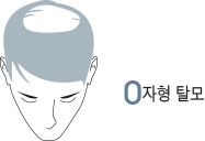 O자형 탈모