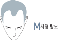 M자형 탈모