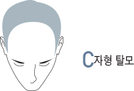C자형 탈모